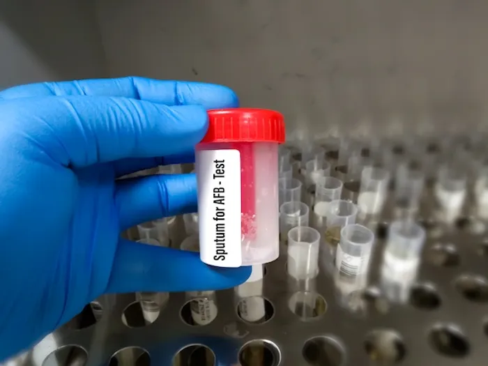 Sputum AFB Test